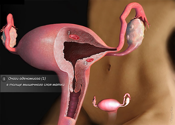 аденомиоз - эндометриоз тела матки